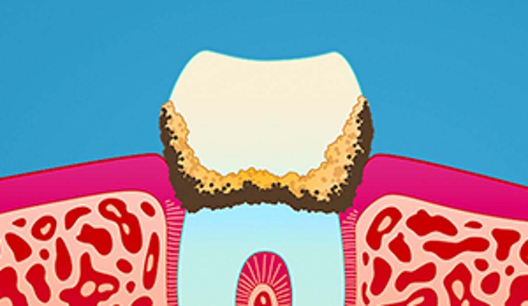 Hva_er_tannstein_w300__480821cba94b4a507b5abfd0cfdf90c9