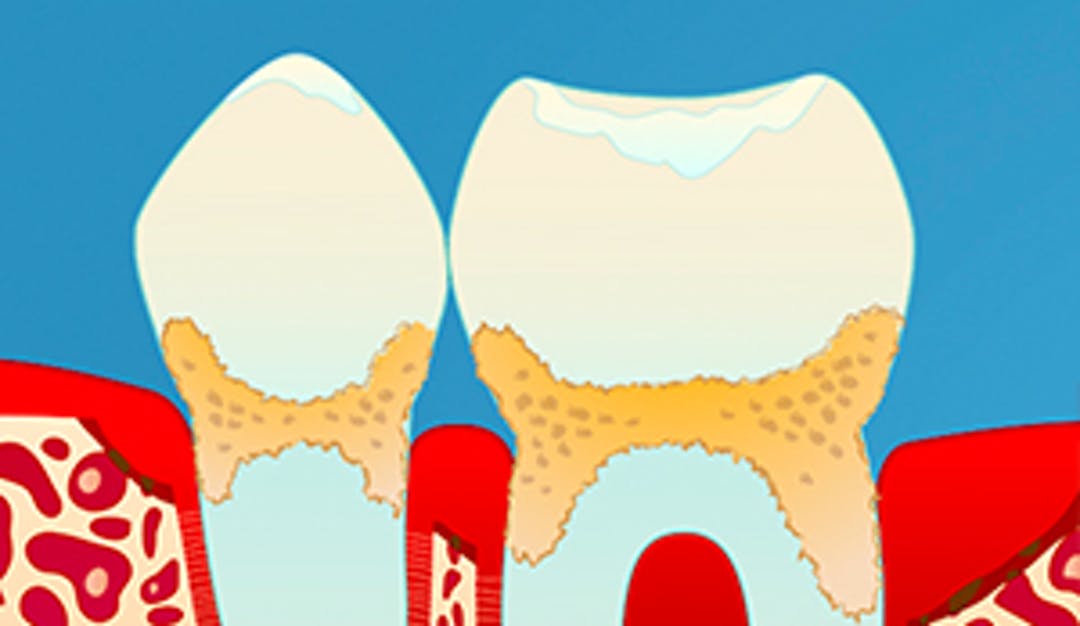 Periodontitt_w300__2ea837f2e7b987604e597ccfb977c4c7